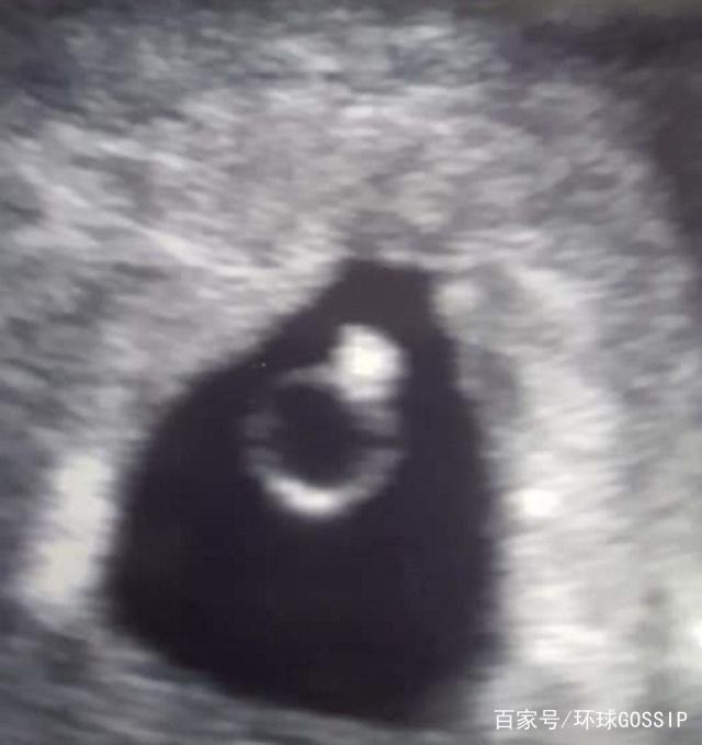 英国妈妈妊娠5周照B超图，图像宛如“一枚钻戒”